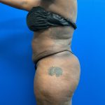 Torso Liposuction Before & After Patient #2753