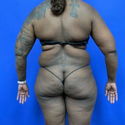Torso Liposuction Before & After Patient #2753