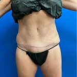 Tummy Tuck Before & After Patient #2772