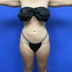 Torso Liposuction Before & After Patient #2744