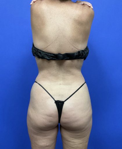 Torso Liposuction Before & After Patient #2744