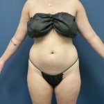 Torso Liposuction Before & After Patient #2744
