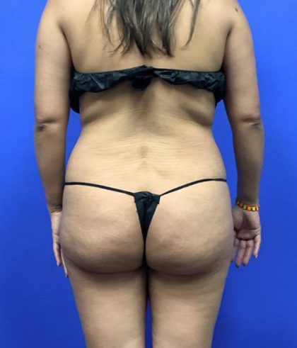Brazilian Butt Lifts (BBL) Before & After Patient #2931