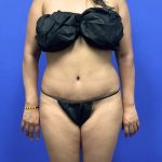 Tummy Tuck Before & After Patient #3000