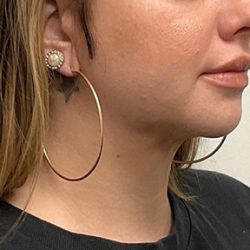 Chin Liposuction Before & After Patient #2991