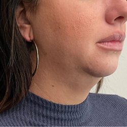Chin Liposuction Before & After Patient #2991