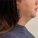 Chin Liposuction Before & After Patient #2991