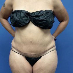 Tummy Tuck Before & After Patient #2992