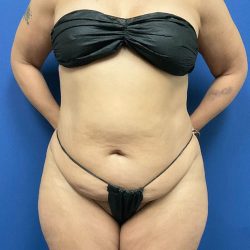 Tummy Tuck Before & After Patient #2992