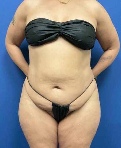 Tummy Tuck Before & After Patient #2992