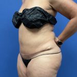 Tummy Tuck Before & After Patient #2992