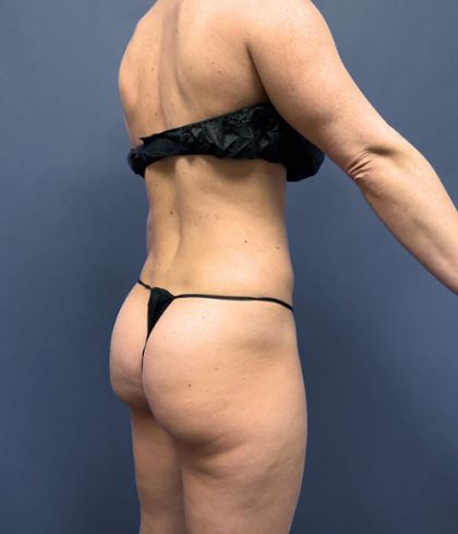 Brazilian Butt Lifts (BBL) Before & After Patient #2993