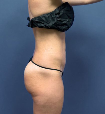 Brazilian Butt Lifts (BBL) Before & After Patient #2993