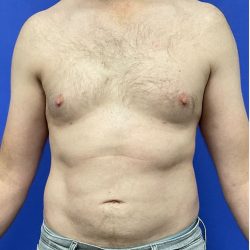 Torso Liposuction Before & After Patient #2994