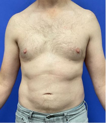 Torso Liposuction Before & After Patient #2994