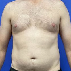 Torso Liposuction Before & After Patient #2994