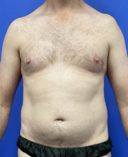 Torso Liposuction Before & After Patient #2994