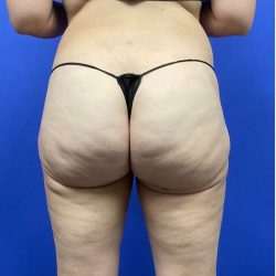 Legs Liposuction Before & After Patient #2995