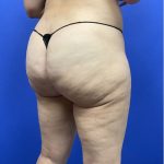 Legs Liposuction Before & After Patient #2995