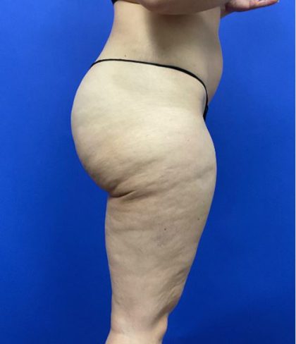 Legs Liposuction Before & After Patient #2995