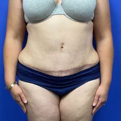 Tummy Tuck Before & After Patient #2996