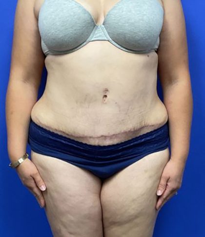 Tummy Tuck Before & After Patient #2996