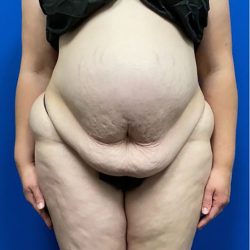 Tummy Tuck Before & After Patient #2996