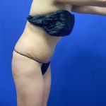 Tummy Tuck Before & After Patient #2997