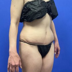 Tummy Tuck Before & After Patient #2997