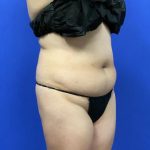 Tummy Tuck Before & After Patient #2997