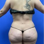 Torso Liposuction Before & After Patient #2999
