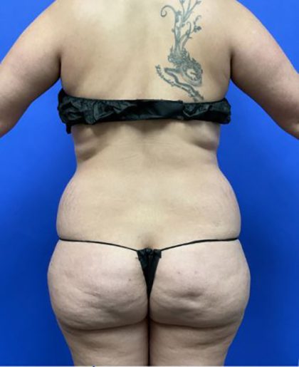 Torso Liposuction Before & After Patient #2999