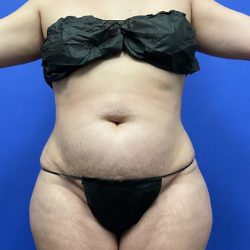 Torso Liposuction Before & After Patient #2999