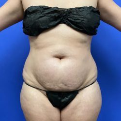 Torso Liposuction Before & After Patient #2999