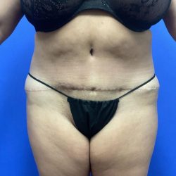 Tummy Tuck Before & After Patient #3091