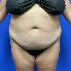 Tummy Tuck Before & After Patient #3091