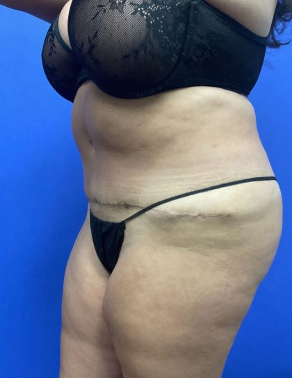Tummy Tuck Before & After Patient #3091