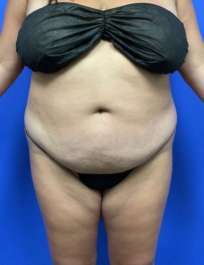 Tummy Tuck Before & After Patient #3091