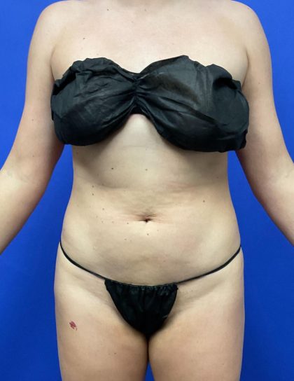 Torso Liposuction Before & After Patient #3084