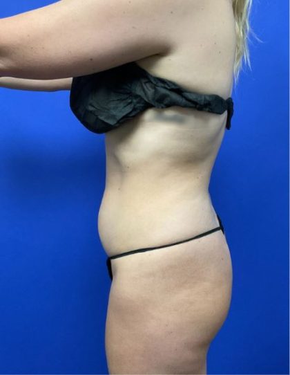 Torso Liposuction Before & After Patient #3084