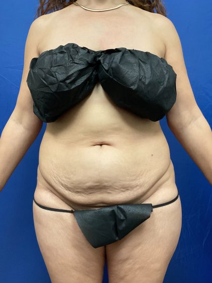 Tummy Tuck Before & After Patient #3354