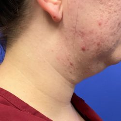Chin Liposuction Before & After Patient #3353