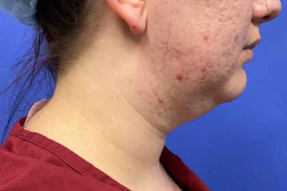 Chin Liposuction Before & After Patient #3353