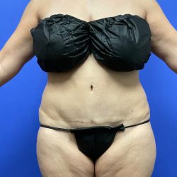 Tummy Tuck Before & After Patient #3354