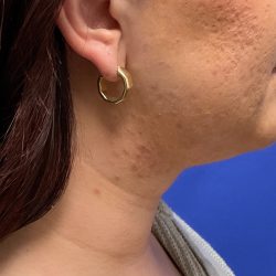 Chin Liposuction Before & After Patient #3353
