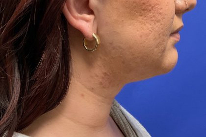 Chin Liposuction Before & After Patient #3353